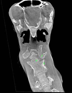 A CT scan of a foal neck with atlanto-axial joint sepsis and associated osteomyelitis of the axis (C2).