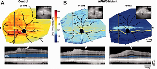 Dogs with a mutation in NPHP5 showed photoreceptor degeneration, though a "streak" of cones was retained.