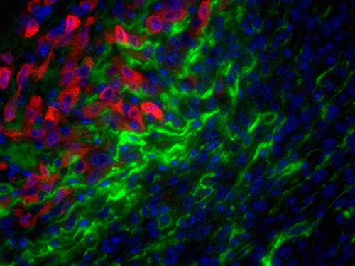 Matrix-degrading enzyme activity (green) clears a pathway for invading breast cancer cells (red) at the tumor-stromal border.