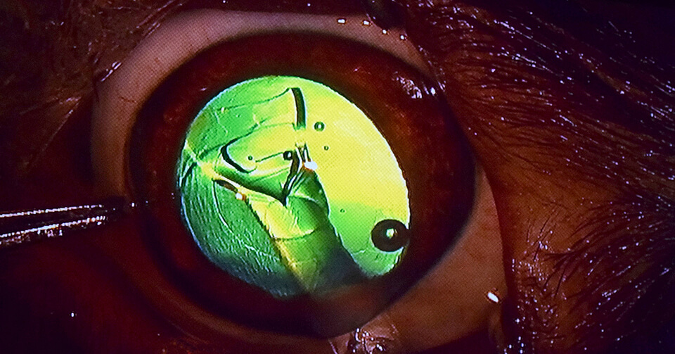 The artificial lens unfolds inside Tucker's eye as it leaves the hypodermic. 
