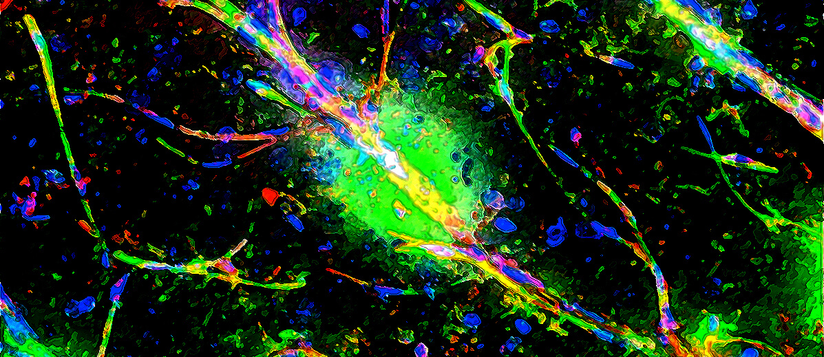 A genetic condition known as 22q.11.2 deletion syndrome is associated with an increased risk of schizophrenia. A Penn Vet-led team found that a leaky blood-brain barrier, allowing inappropriate immune involvement in the central nervous system, may contribute to this or perhaps other neuropsychiatric conditions.