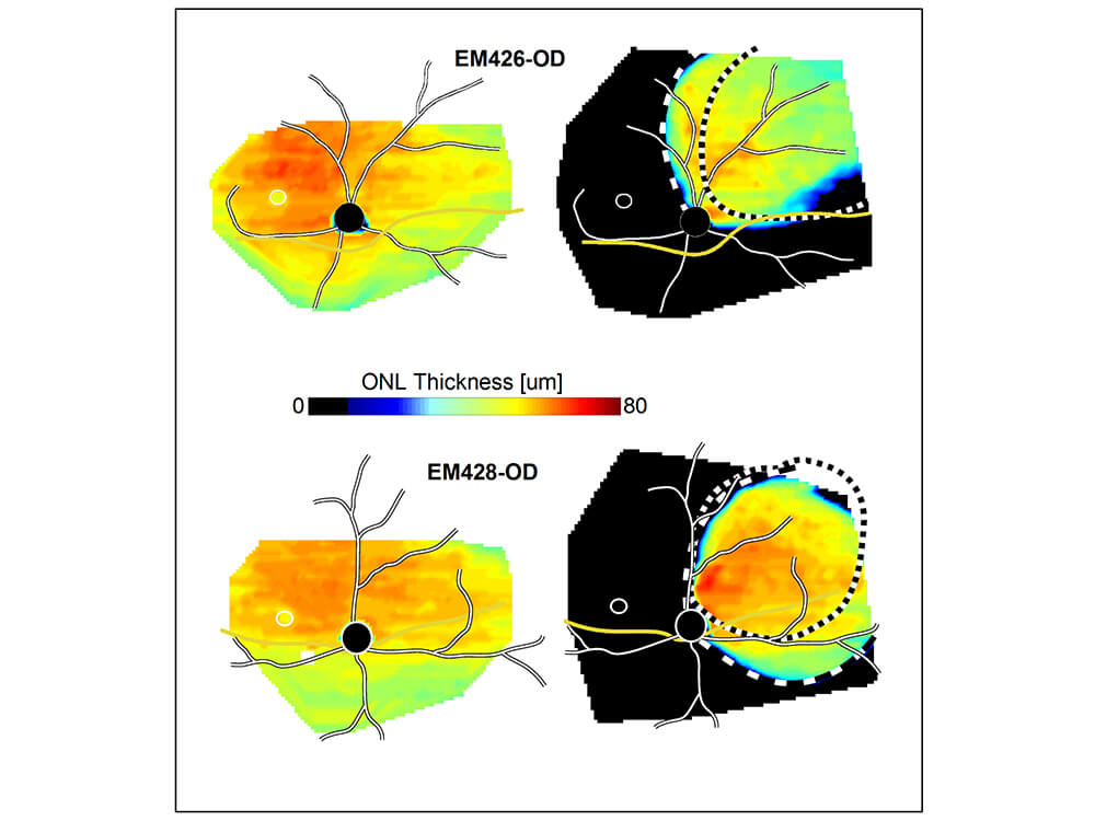 Maps reflecting the thickness of a key layer of the retina show how a gene therapy treatment (right panels) protected against several retinal degeneration.