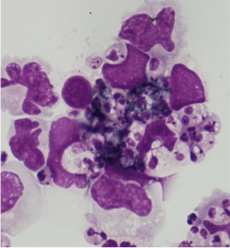 Human Monocytes infected with anastigotes