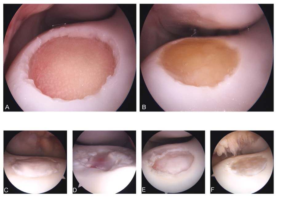 Arthroscopic images of empty (a), implanted (b) and healing defects 8 weeks postimplantation (c-f)