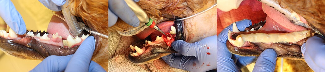 Left to right: A step in the mandible that can be observed by different levels of the gingival margins of the teeth; the extraction of the unerupted tooth bud that was embedded in the bone of the mandible; the intraoral splint in place after treatment of the diseased teeth in the region and stabilization of the mandibular fracture.
