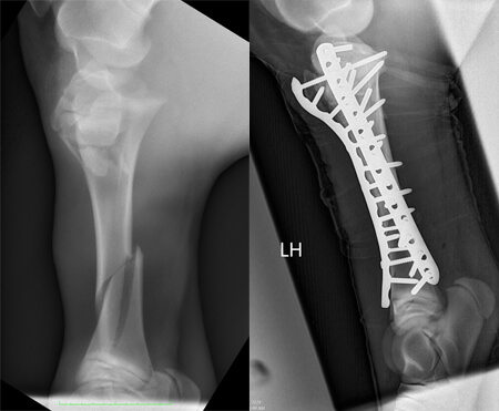 Pre-op (l) and post-op radiographs of Osada's fractured tibia