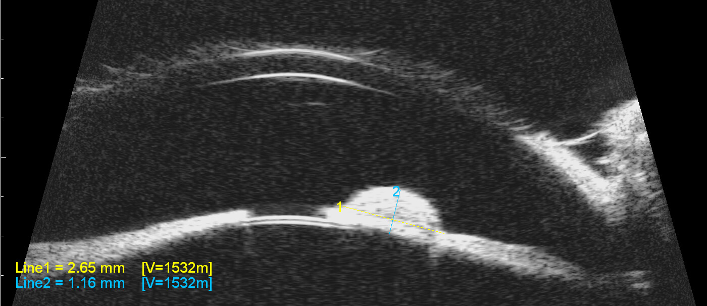 An ultrasound biomicroscopy image of Sheeba's eye before laser surgery showing a side view of the lesion