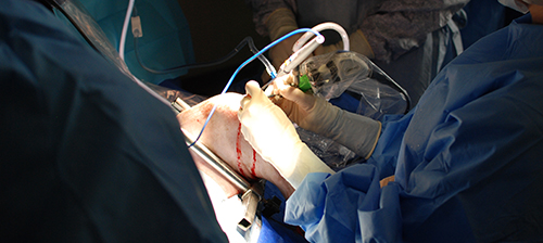 A close-up of arthroscopic surgery
