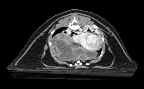 A CT image of Brianna's chest showing the thymoma.