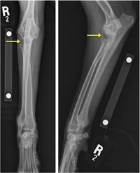 X-rays of Brody’s right limb showing the short radius bone and the gap in the elbow joint (yellow arrow).
