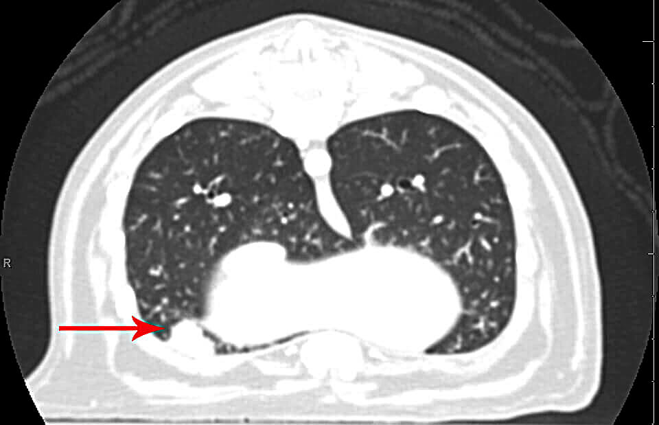 The red arrows points to Dingus' lung tumor revealed in this CT image