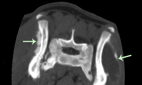 This CT scan of Max's pelvis shows osteomyelitis of the bone at left. The dark region at right is an abscess.