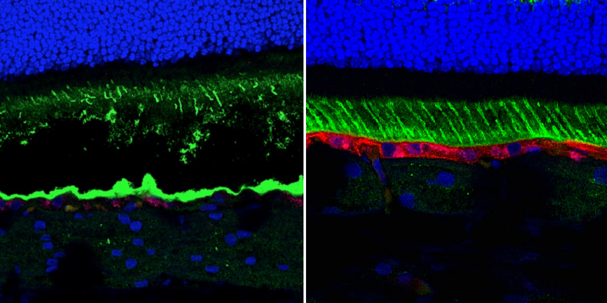 Gene therapy successfully treated a canine version of Best disease, a blinding disorder, the effects lasting more than five years. In these images of the retina of untreated (left) and treated (right) dogs, one can see that BEST1 gene expression (in red) was restored following treatment. In addition, the threrapy restored the structure of the RPE (bottom green layer), a layer of cells that supports the light-sensing photoreceptor cells.