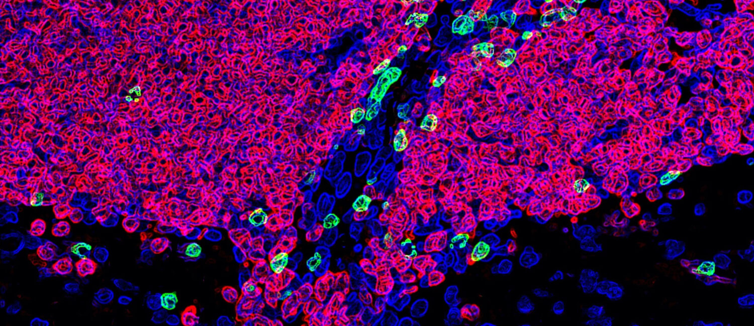 A naturally occurring canine disease called granulomatous meningoencephalomyelitis replicates many features of multiple sclerosis, including the involvement of B cells (in red) and T cells (green) in the tissues that line the central nervous system. (Image: Penn Vet)