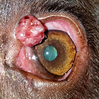 eyelid tumor