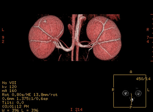 CT scan of kidneys