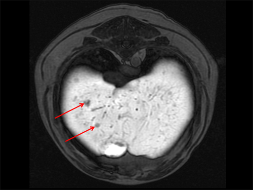 Liver with multihance MRI