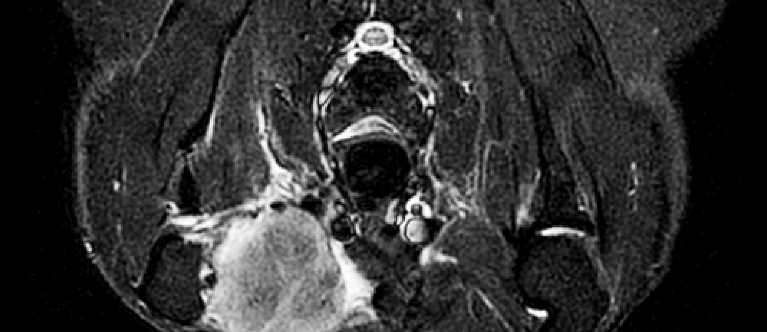 MRI brachial plexus mass STIR