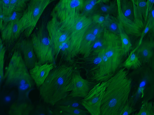 Invading Breast Cancer Cells