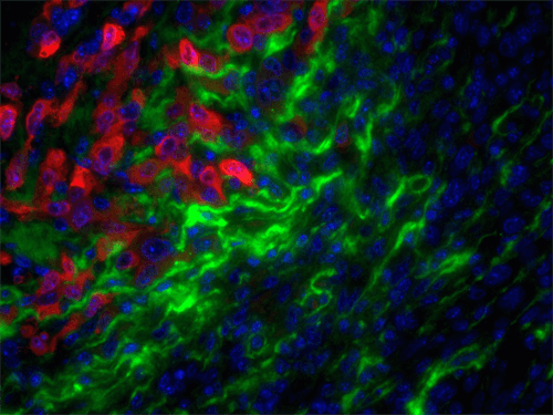 Invading Breast Cancer Cells