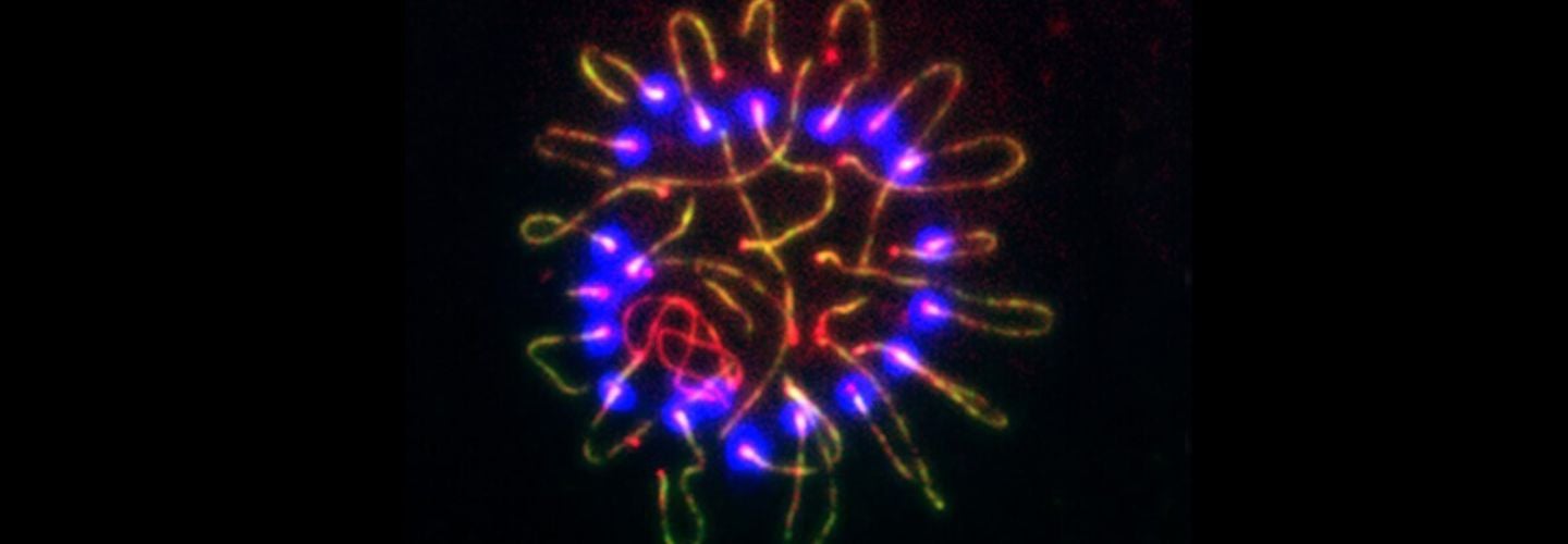 Abnormal clustering of chromosomes, labeled with florescent purple and yellow