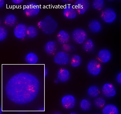 Lupus patient activated T cells