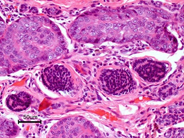 cancer slide