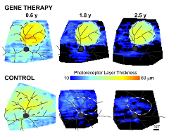 Blue and green graph of tetinitis