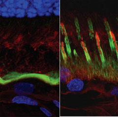 Macular degeneration