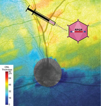 Illustration of x-linked retinitis