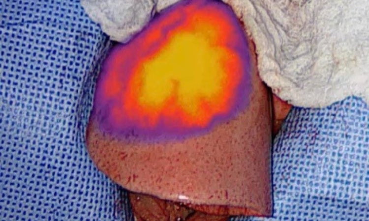 A surgical view of a lung with a thermographic overlay showing heat distribution, surrounded by medical drapes.